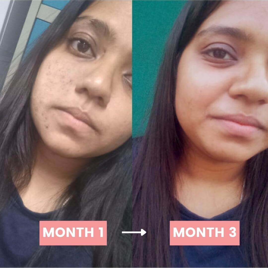Before and After Glutathione Forte